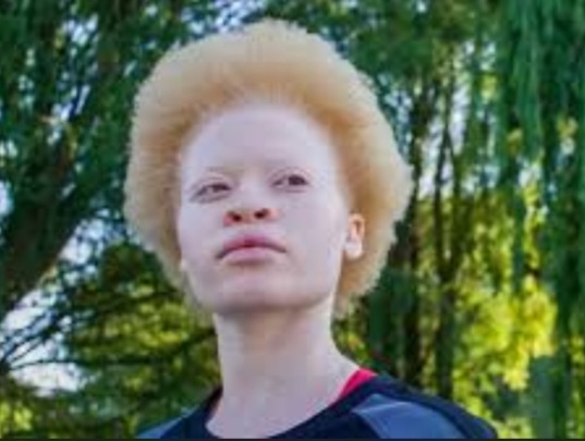 Garu MP urges end to discrimination against persons with albinism